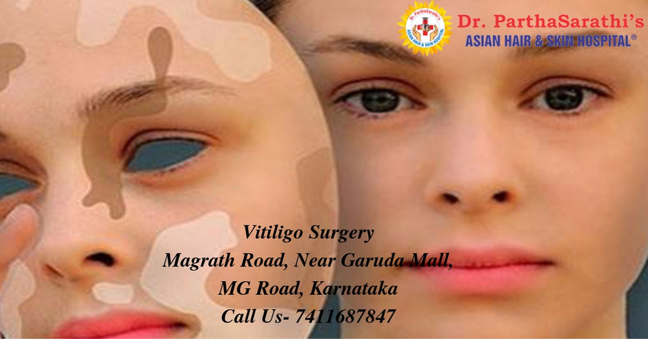 You Will Never Thought That Knowing Vitiligo Surgery in Bangalore Could Be So Beneficial!