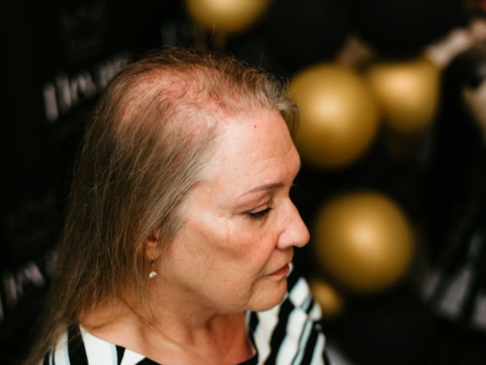 Overall Hair Thinning