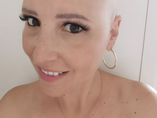 Alopecia feminina: tipos, causas e como lidar com ela