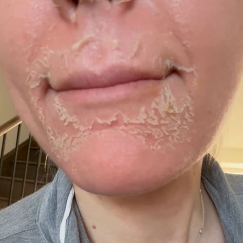 Introducing The Cold Peel: Your Ultimate Guide to Our Deepest Peel Yet