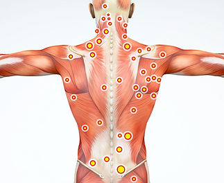 myofascial_pain_syndrome_trigger_points_99450800_ML_cropped.jpeg