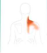 Trigger Point on Levator Scapulae Muscle