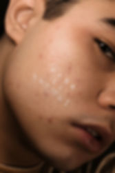 acne chico.jpeg
