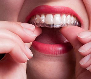 traitement gouttières invisibles