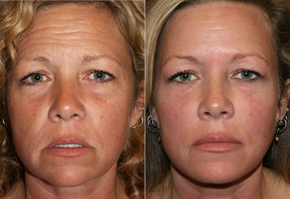 Botox and fillers, Medspa Safety Harbor, Full Facial Recontouring