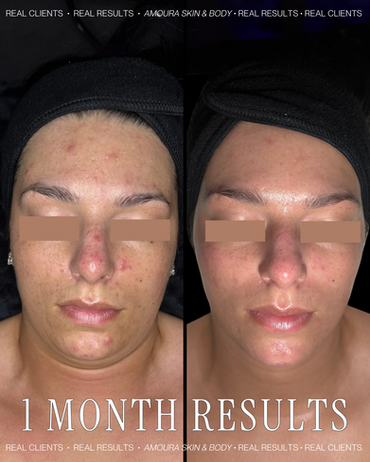 Acne facial Beaverton Oregon extractions congestion treatment adult acne skin transformation