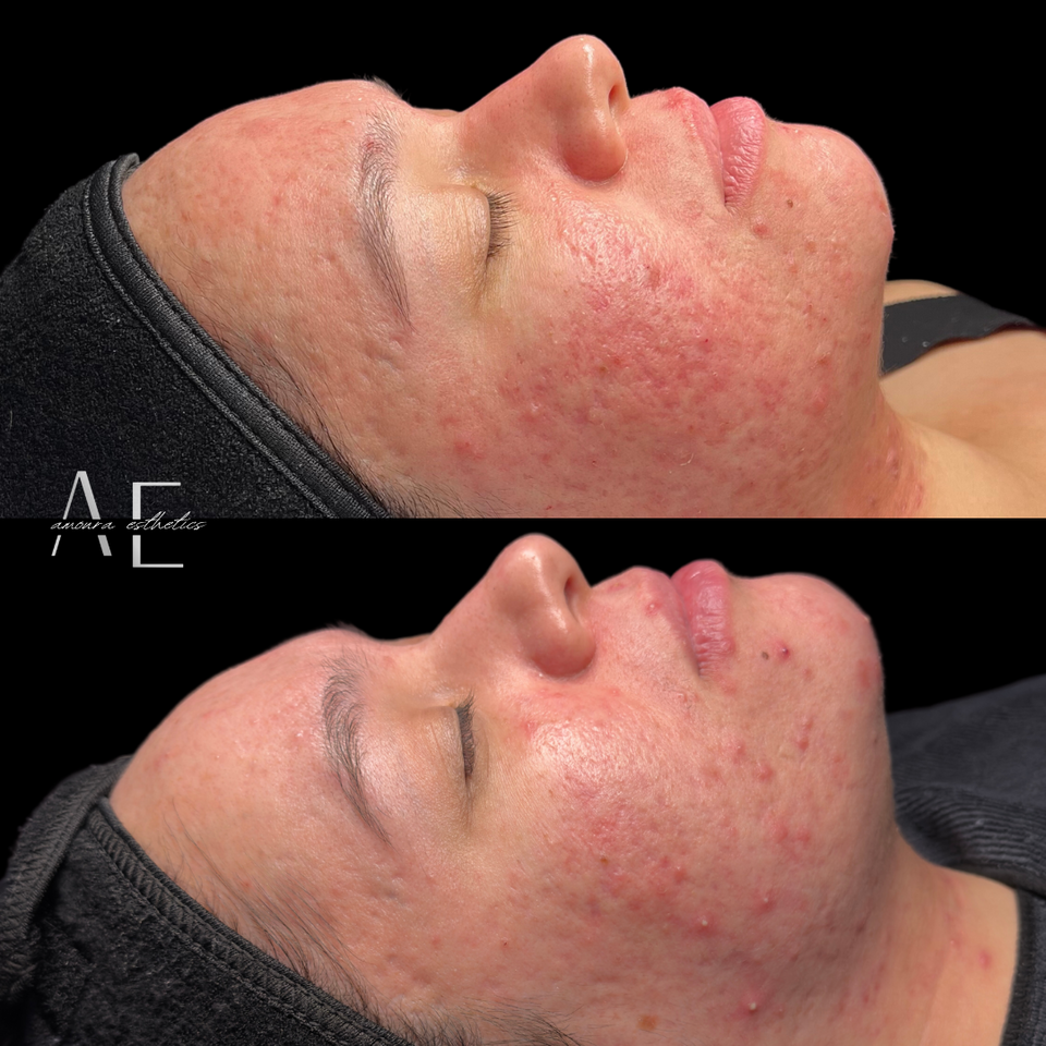 Pigmentation correction results using Glacial RX facial near Portland instead of IPL photofacial