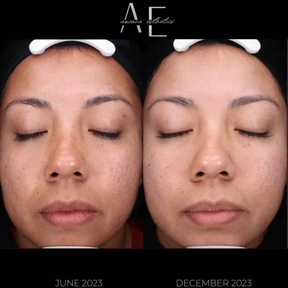 Dermaplaning and Hydrafacial glow result in Beaverton before a girls spa day at Amoura Skin and Body