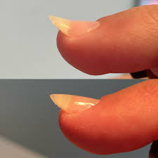 upward growing nail
