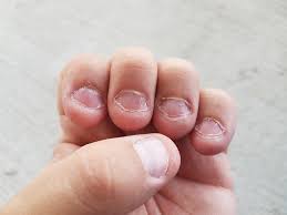 bitten nails