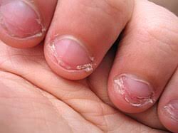 bitten nails