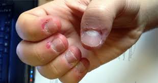skin picker