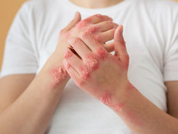 Dermatite de contato