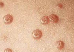 Condiloma: sintomas, transmissão e tratamento das verrugas por HPV