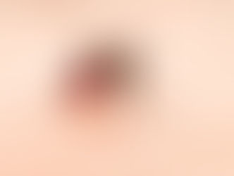 Dengue: causas, sintomas, prevenção e tratamentos