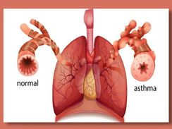 Asma: o que é, prevalência, mortalidade, etiologia e tratamento