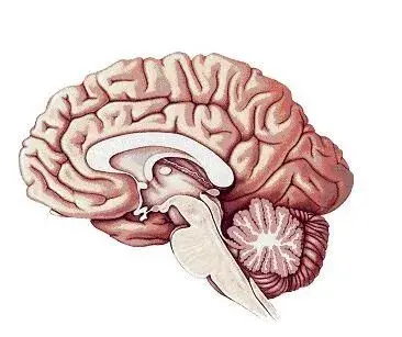 Hemorragia Intracraniana