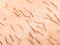 Pilosidade excessiva