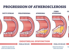 Doença Arterial Crônica de Membros Inferiores (DACMI), também conhecida como Doença Arterial Obstrutiva Periférica (DAOP), é uma condição resultante do estreitamento e endurecimento das artérias periféricas, principalmente devido à aterosclerose