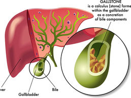 colelitíase, cálculo biliar