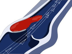 Trombólise farmacomecânica dirigida por cateter para trombose venosa profunda