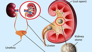 Litíase urinária: diagnóstico e tratamento