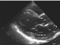 Prolapso da valva mitral (PVM)