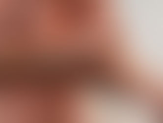 Lúpus eritematoso sistêmico (LES)