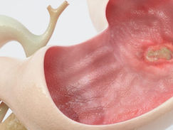 Úlcera duodenal