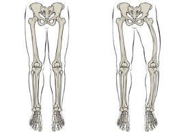 Doença de Paget óssea