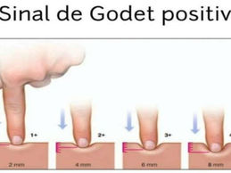 edema: sinal de godet