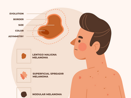 Infográfico de melanoma de design plano desenhado à mão