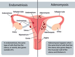 Endometriose: segunda patologia mais comum na ginecologia