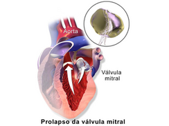 Prolapso da válvula mitral