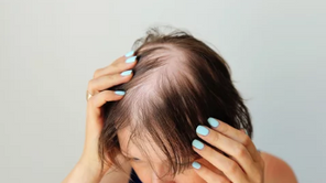 Teste: explorando a alopecia