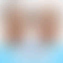 Filler before and after photo