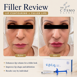 Filler Before and after (14)