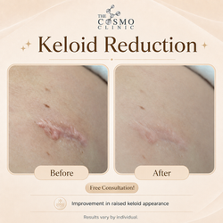 Keloid Reduction Treatment Before After (2)