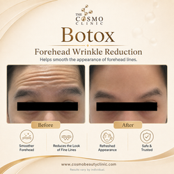 Botox Before After (1)