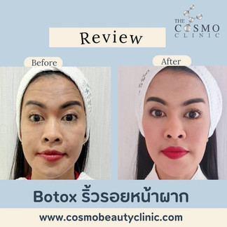 Botox before and after photo
