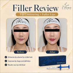 Filler Before and after (1)