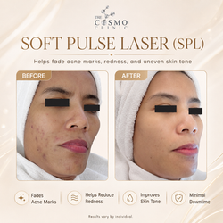 SPL Before After (2)