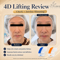 4D Lifting Before After (2)