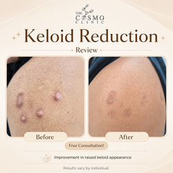 Keloid Reduction Treatment Before After (4)