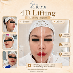 4D Lift Before After