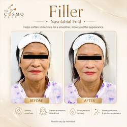 Filler Before After (17)