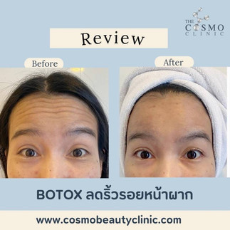 Botox before and after photo