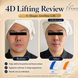 4D Lifting Before After (1)