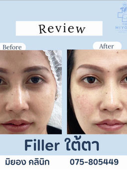 dermal filler lips.jpg
