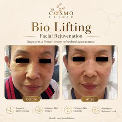 BLF Before After (2)